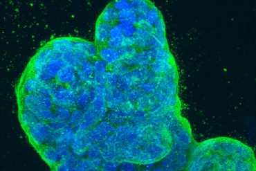 Science image of breast cancer cells. 