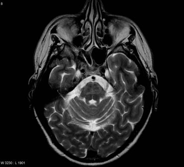 New Type Of Prion May Cause, Transmit Neurodegeneration | UC San Francisco