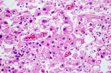 a microscopic view of metastatic hepatocellular carcinoma