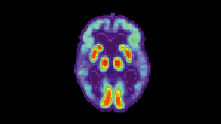 a PET scan of the brain of a person with Alzheimer's disease