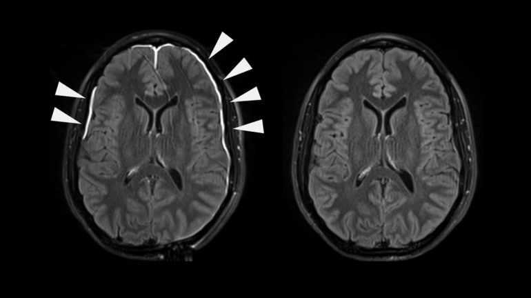 an MRI shows damaged mengis in the brain after an injury and then the same brain a week later without damage