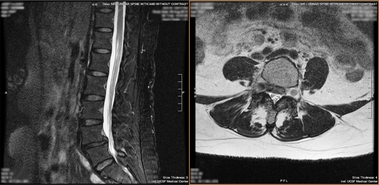 an MRI of a patient ahead of their awake spine surgery