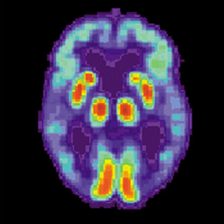 PET scan of a brain with Alzheimer's