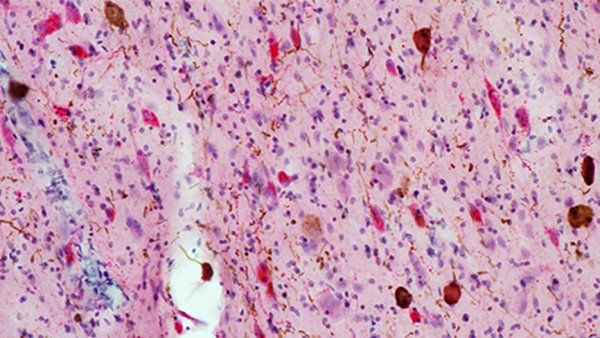 Microscopic image of Alzheimer’s disease tissue.