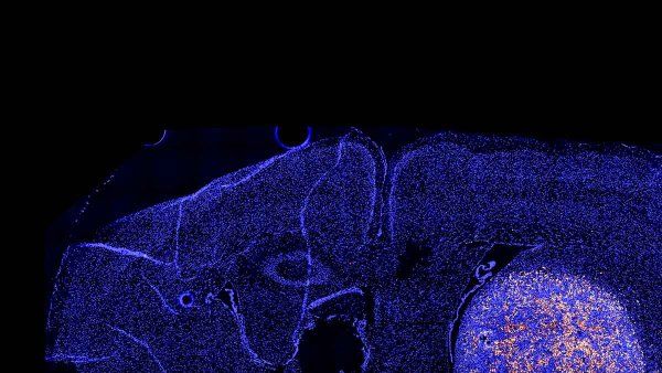 A scientific image of T-cells attacking a glioblastoma (brain tumor).
