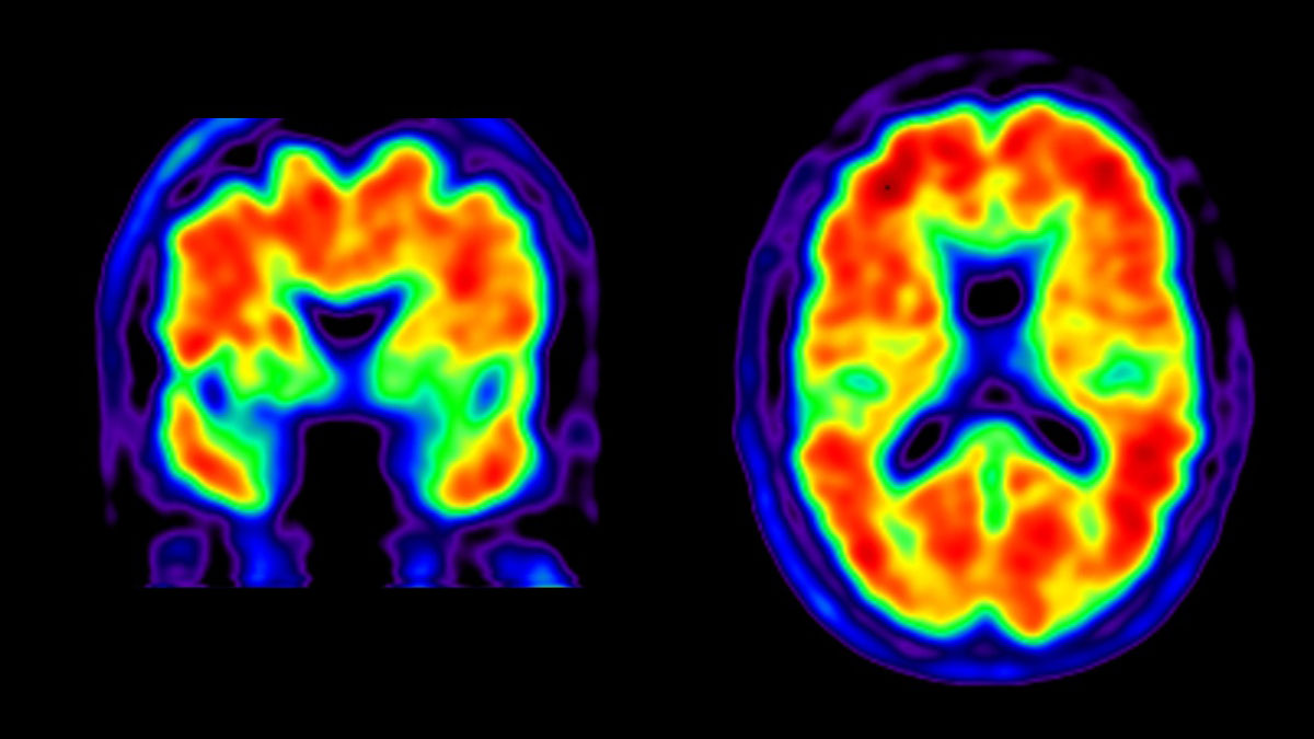 Alzheimer's Diagnosis, Management Improved by Scans | UC San Francisco