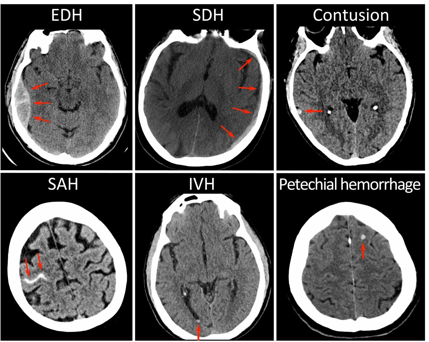 For Concussion Patients CTs Offer Window Into Recovery Mirage News