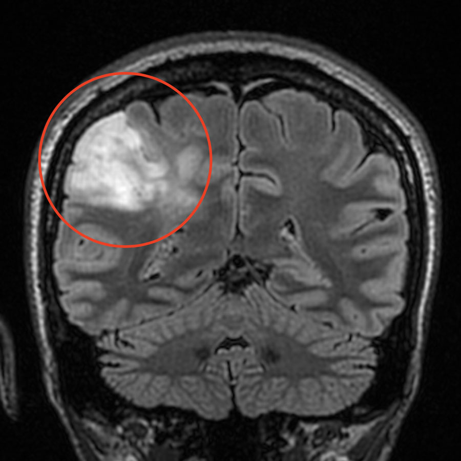 Brain Tumor Xray