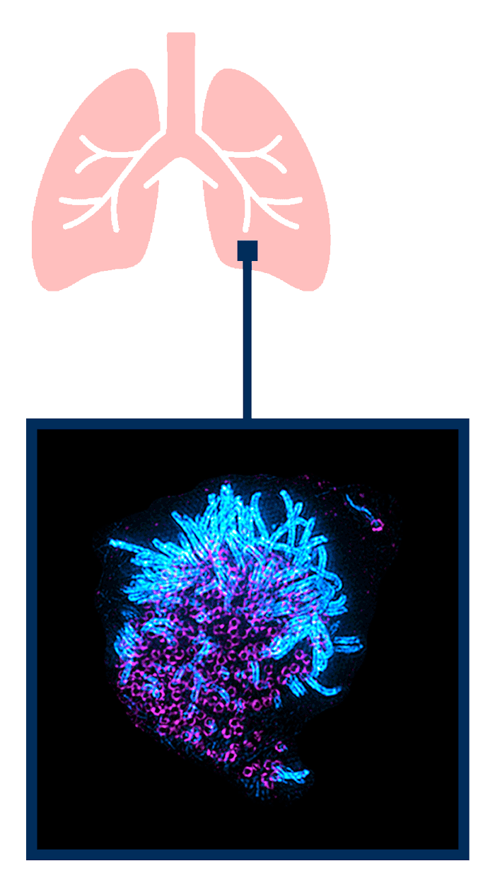 A microscopy of two lung cells that are multiciliated. Above it is a graphic icon of a set of lungs to show the cells are located in the lungs.