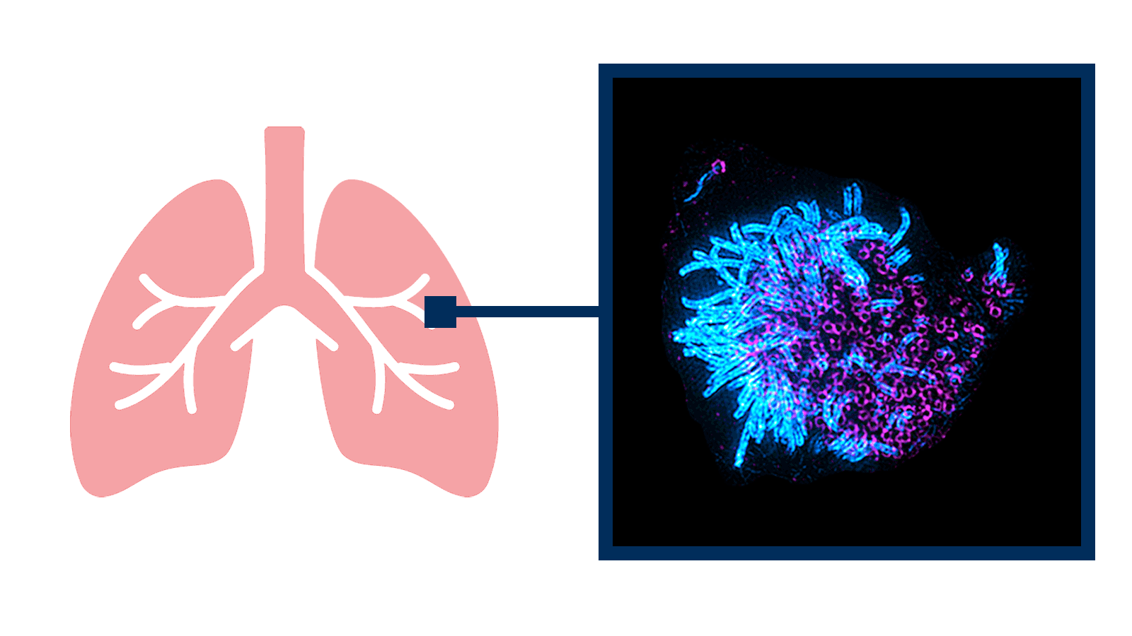 A microscopy of two lung cells that are multiciliated. Besides it is a graphic icon of a set of lungs to show the cells are located in the lungs.