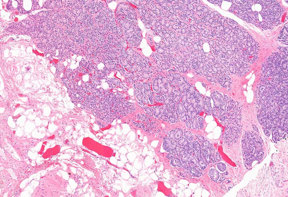 A microscopic image showing higher levels of carcinoma in prostate tissue.