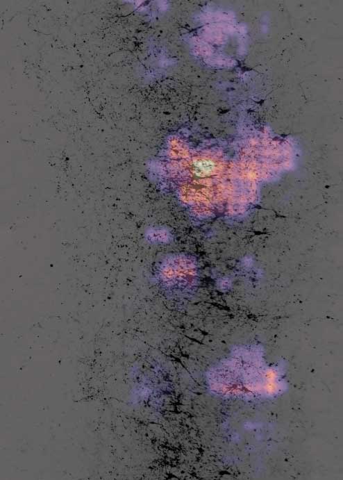 An image showing exising epliectic acitvity, with bright spots of orange and yellow among signaling epilepsy.