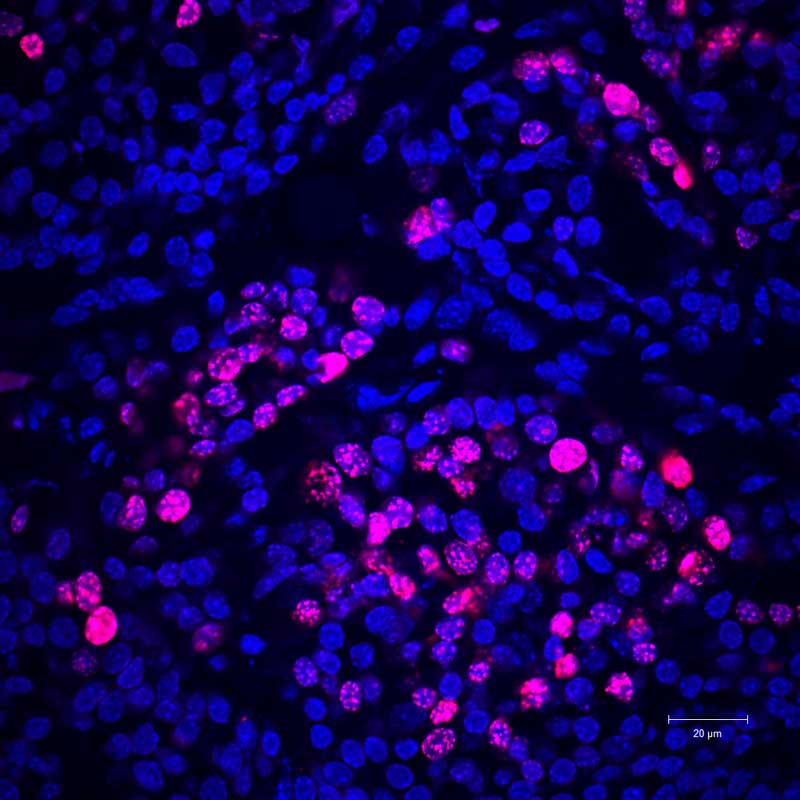 A microscopic image showing actively multiplying cancer cells, dyed in pink, in a mouse.