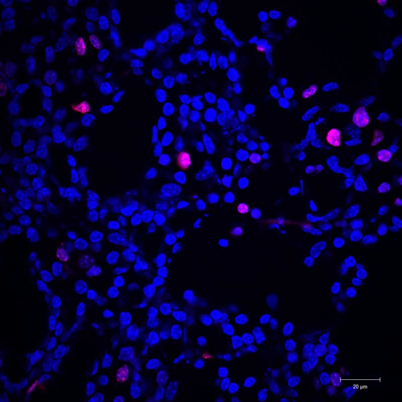 A microscopic image showing less actively multiplying cancer cells, dyed in pink, in a mouse after fat cells were introduced.