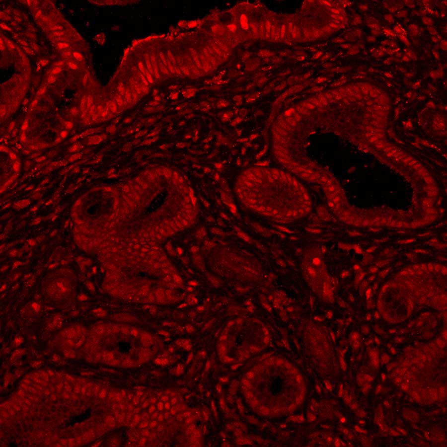 Microscopy showing presence of the MYC protein, dyed red, in a pancreatic tumor.