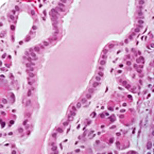 A microscopic image showing a normal pancreas duct, free of cancerous cells.