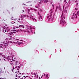 A microscopic image showing a pre-cancerous pancreas duct.