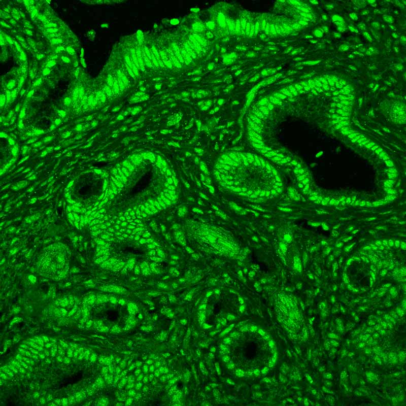 Microscopy showing presence of the RBM2 protein, dyed green, in a pancreatic tumor.