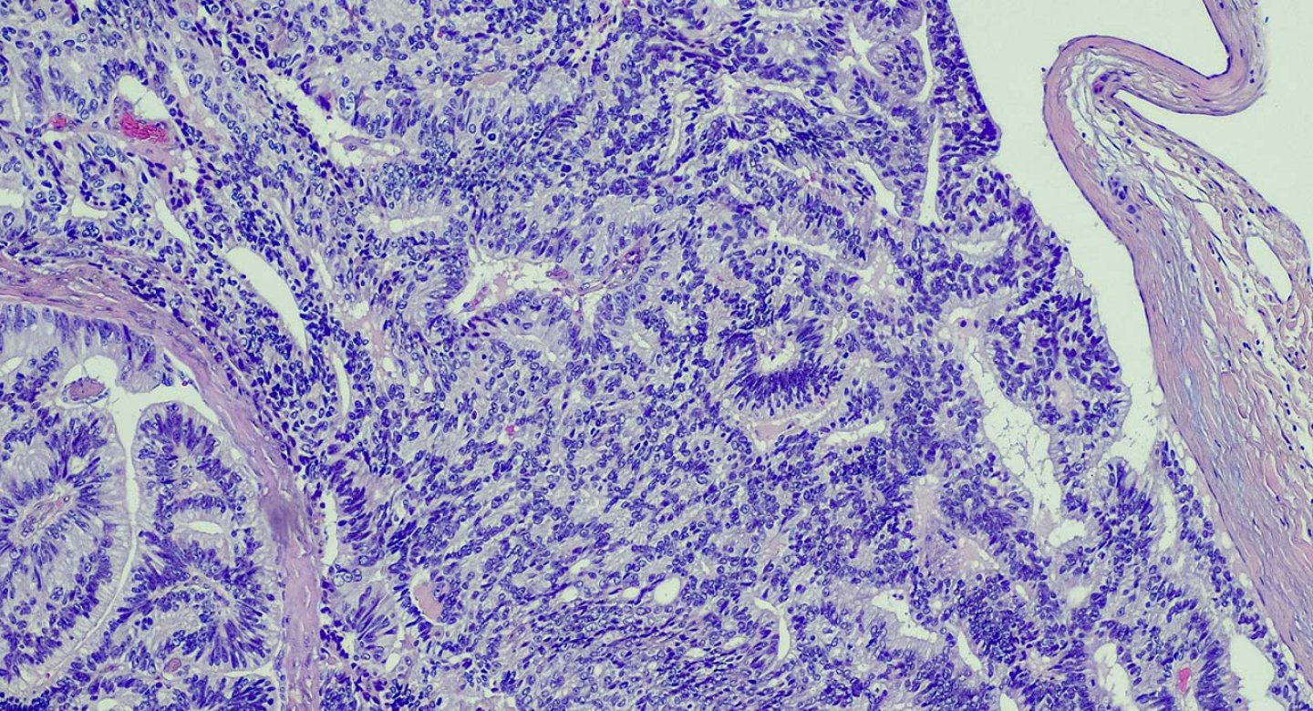 Microscopy of prostate cancer