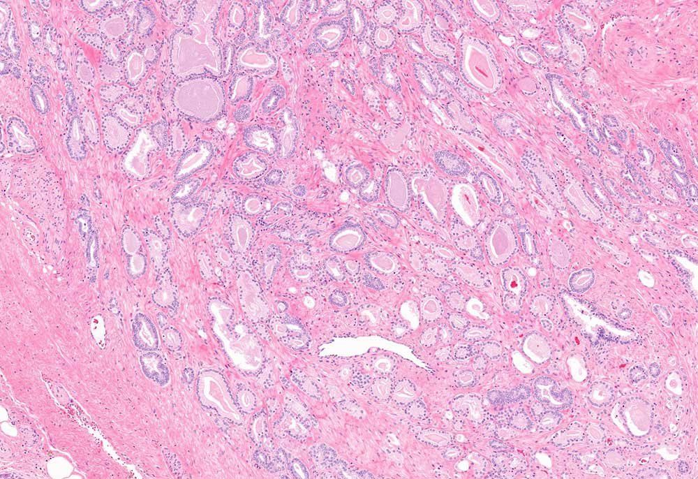 A microscopic image showing small levels of carcinoma in prostate tissue.