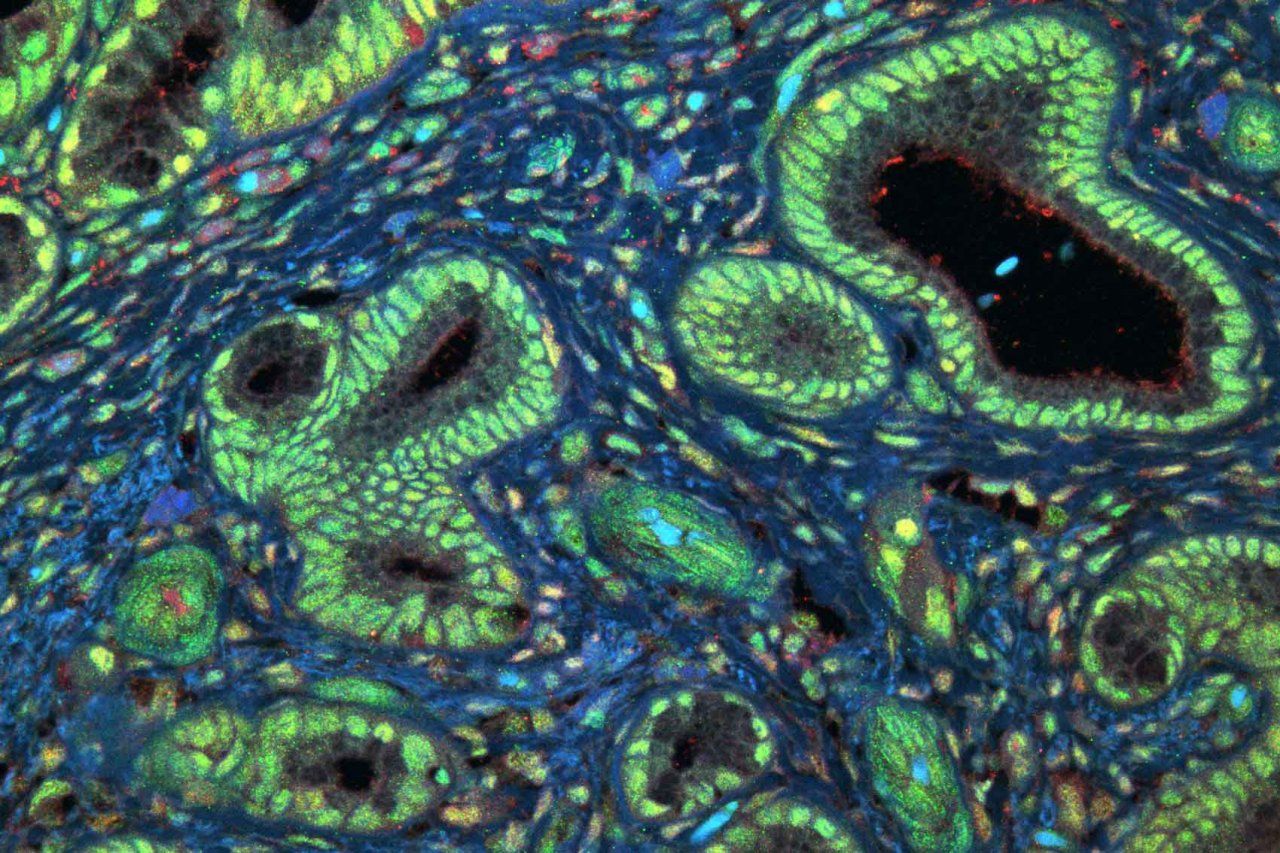 Microscopy showing the growth protein, MYC (red) and the RBM42 protein (green) in a representative pancreatic tumor biopsy from a patient.