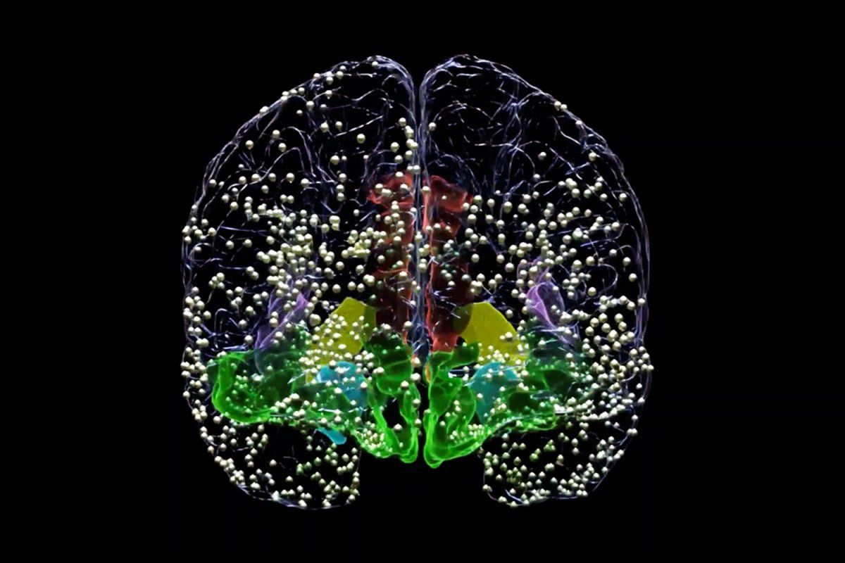 Brain image illustrating electrode recording sites