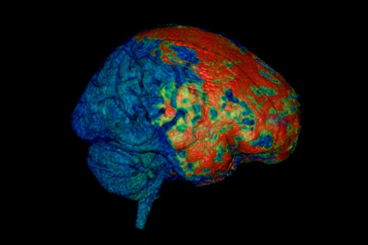 an MRI scan of a brain with a concussion