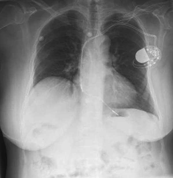 X-ray of patient showing pacemaker.