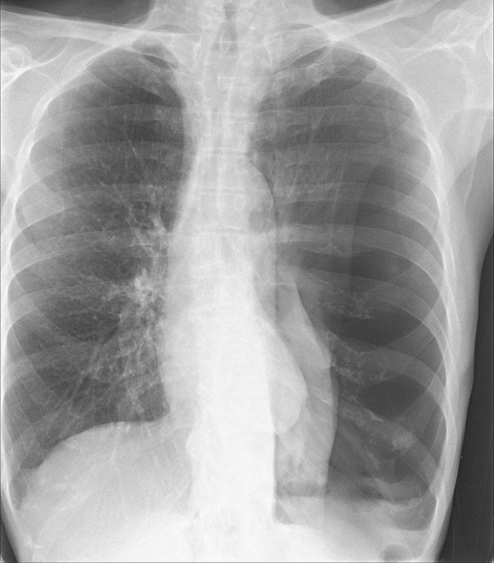 Artificial Intelligence That Reads Chest X-Rays Is Approved by FDA 