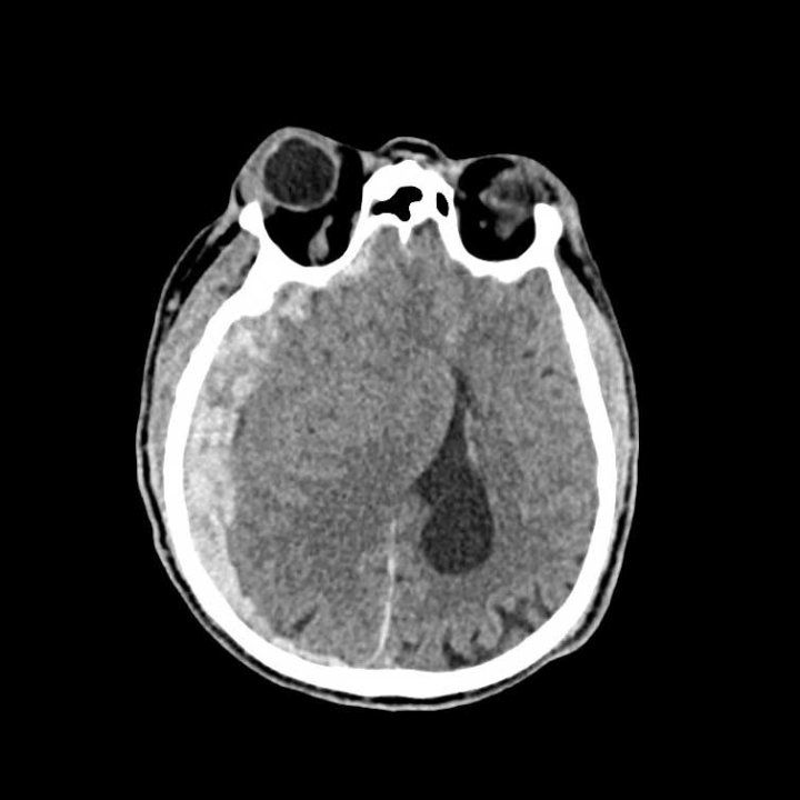 A CT scan of a traumatic brain injury.