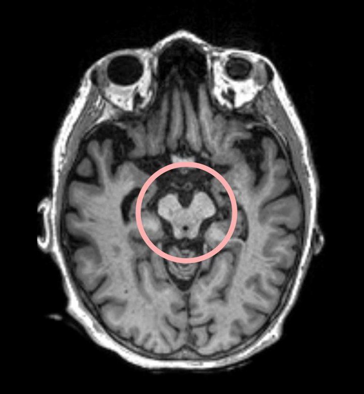 A brain scan showing the presence of progressive supranuclear palsy.
