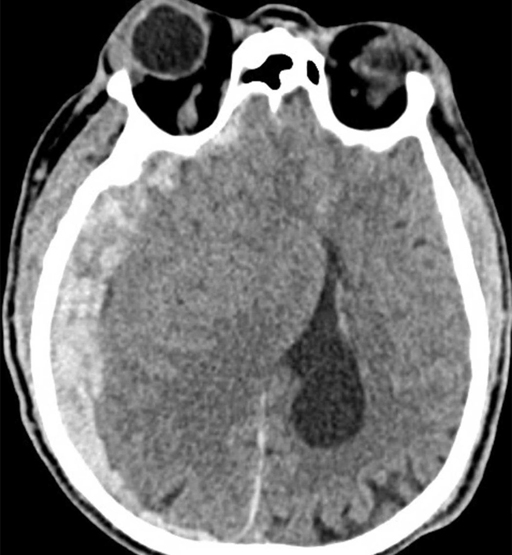 A CT scan of a traumatic brain injury.