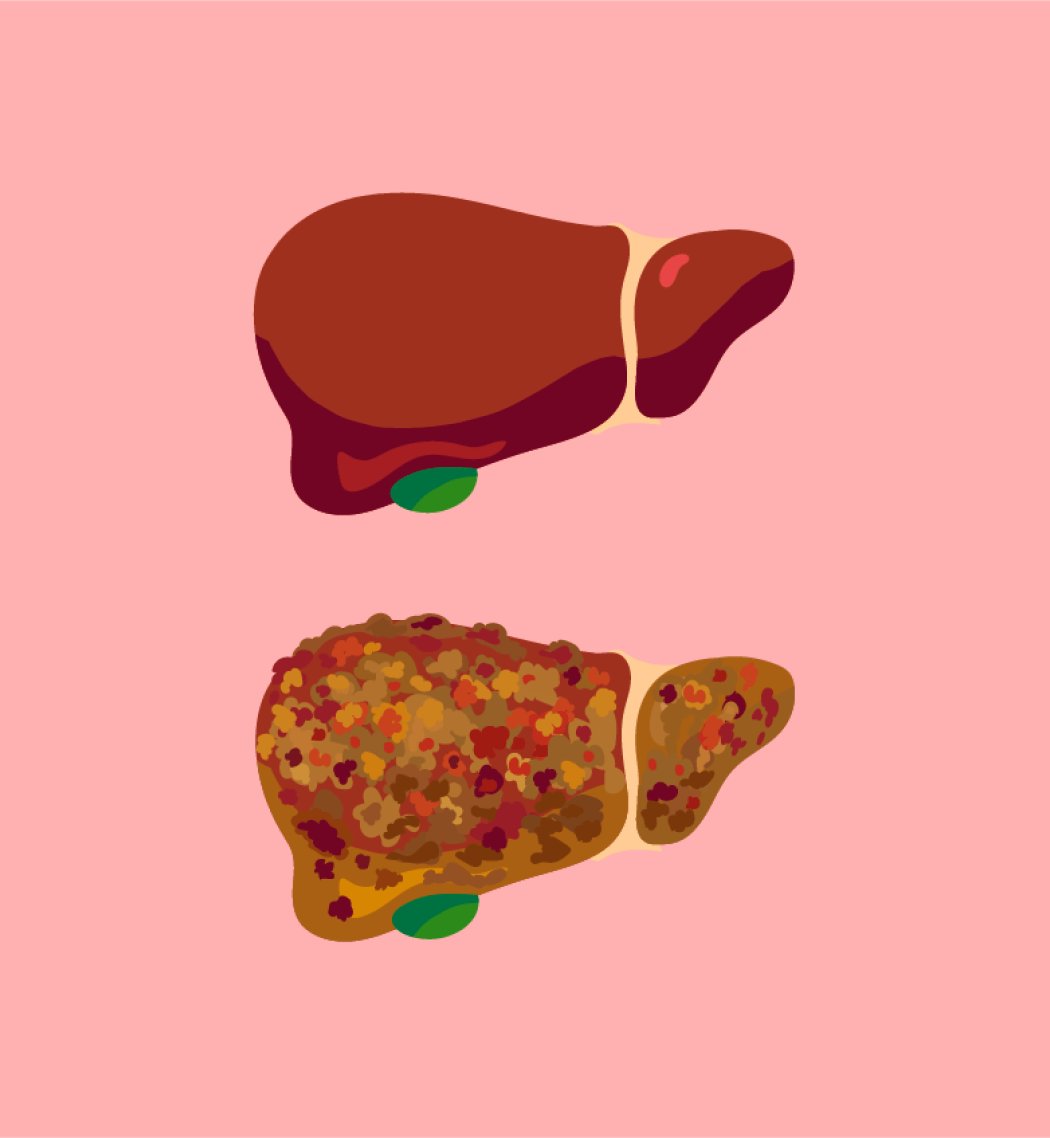 Graphic illustrations showing a healthy liver, and a spotted, diseased liver.